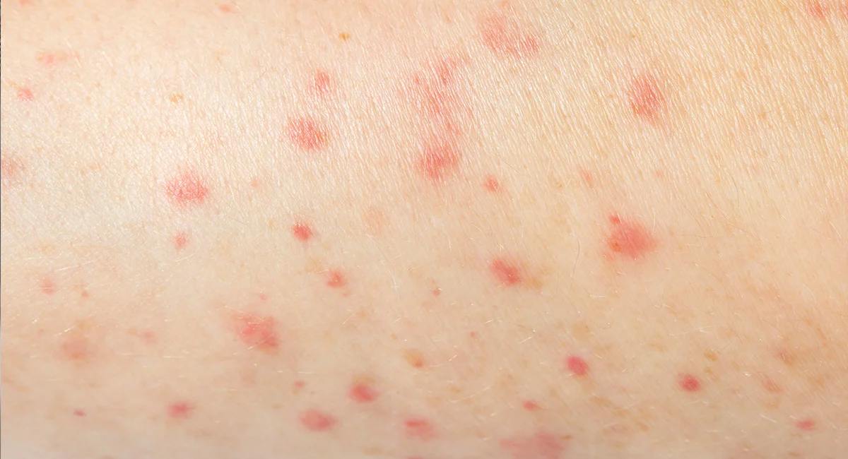 Jasa Basmi Kutu Kasur