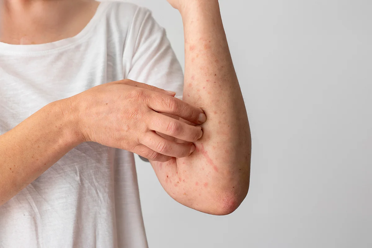 bahaya lalat pada makanan